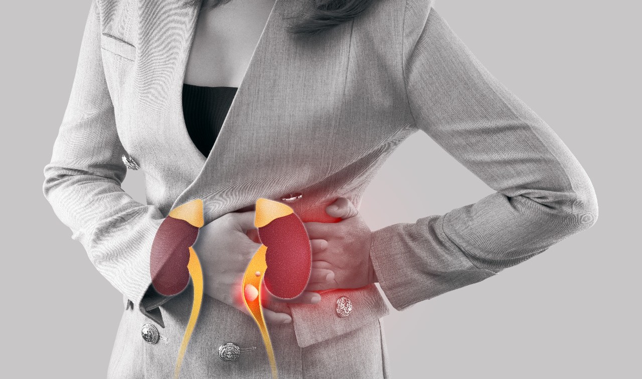 How to Prevent Kidney Stones Naturally