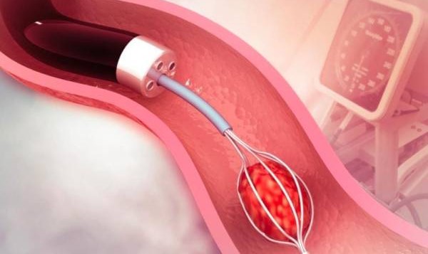 Freedom from Kidney Stones with Advanced RIRS