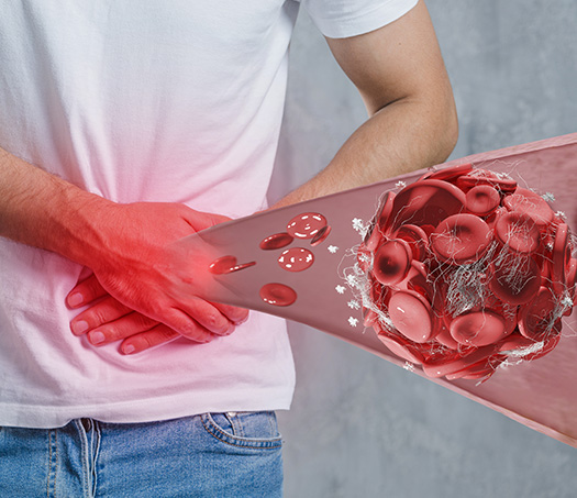 Kidney Stone Management